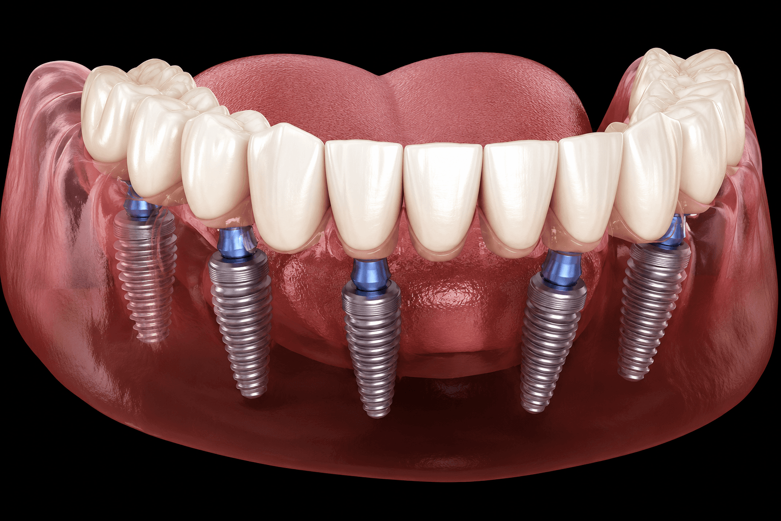 Advanced Implants